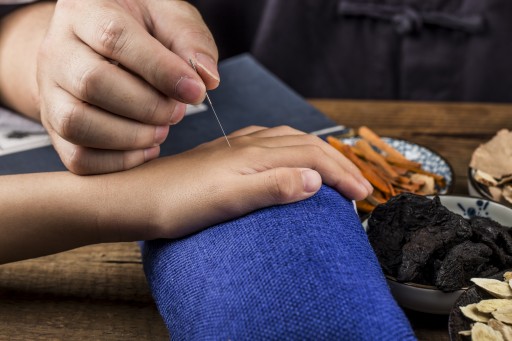 Akupunkturbehandlung an einer Hand in Nahaufnahme, daneben Heilkräuter